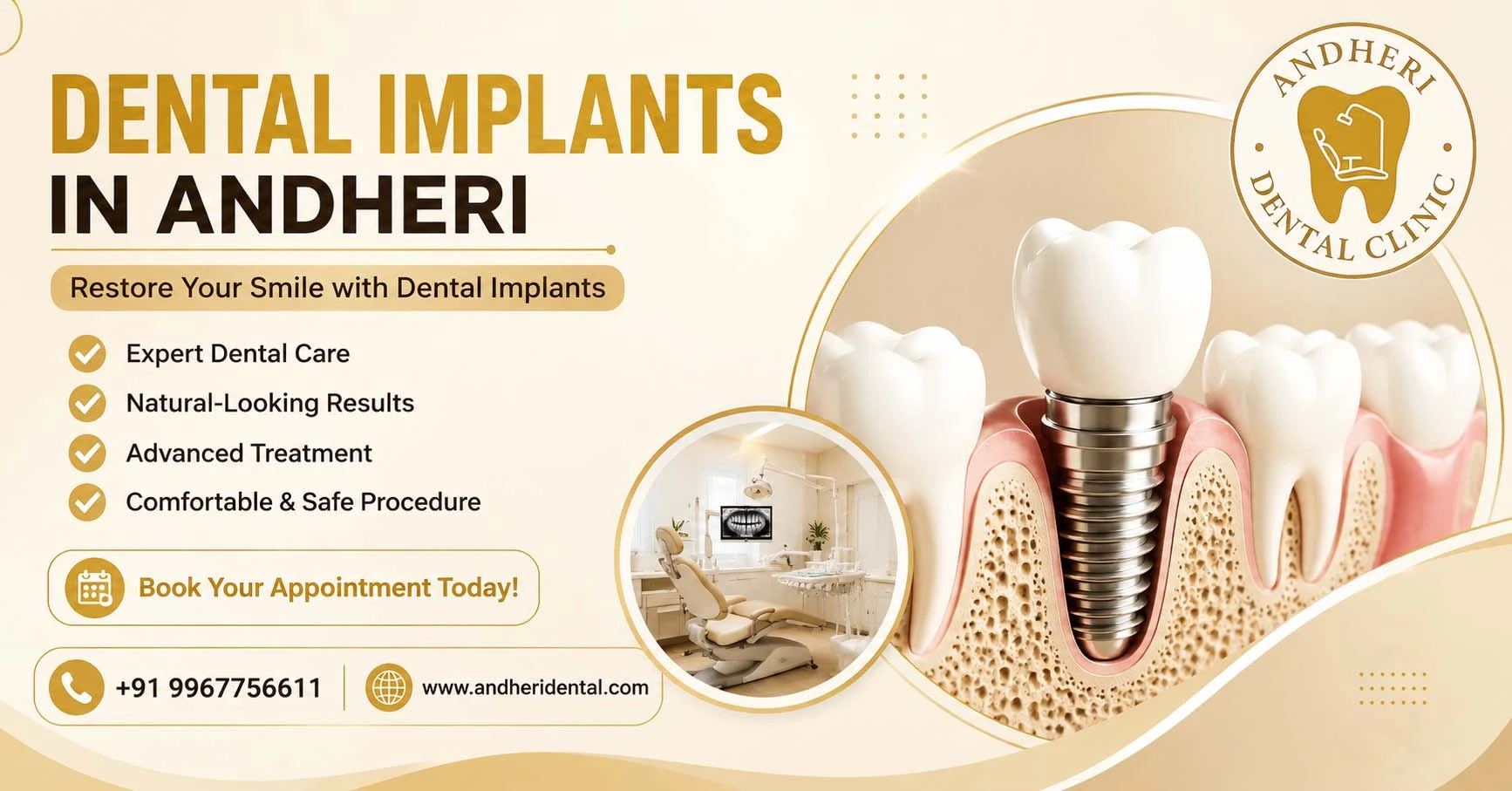 Dental Implants in Andheri